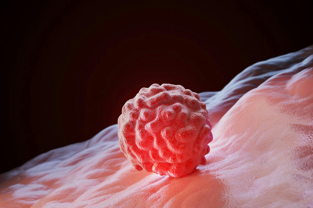 Alimentazione, ambiente e stili di vita sani: il ruolo chiave per prevenire i tumori